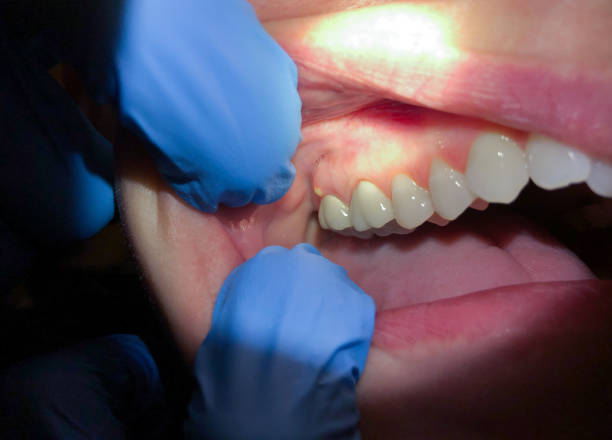 Best Emergency Dental Care for Broken or Chipped Teeth in Northeast Ithaca, NY